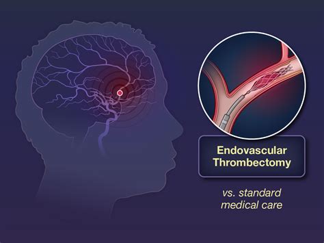 thrombectomy stroke